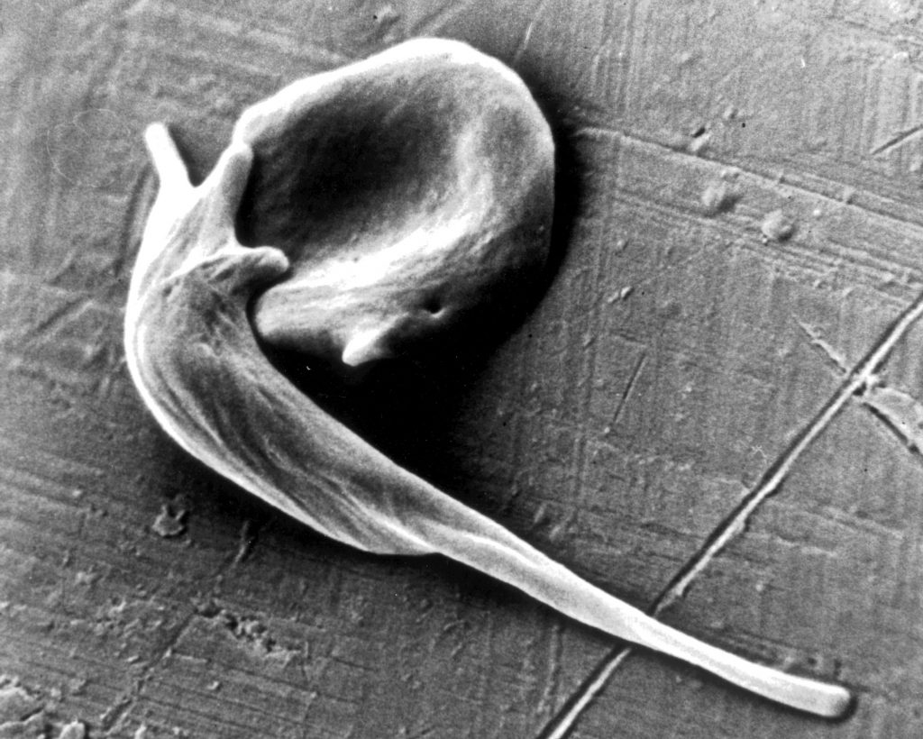 Sickle hemoglobin polymerizes under low oxygen tensions in the tissues and the red blood cell deforms, which leads to obstruction in the capillaries and painful episodes for the patients
