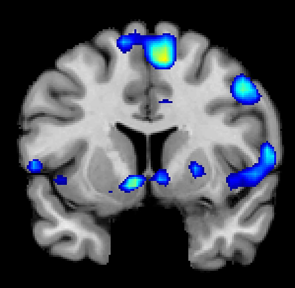 An fMRI scan shows regions of the brain that become active when devoutly religious study participants have a spiritual experience, including a reward center in the brain, the nucleus accumbens.
